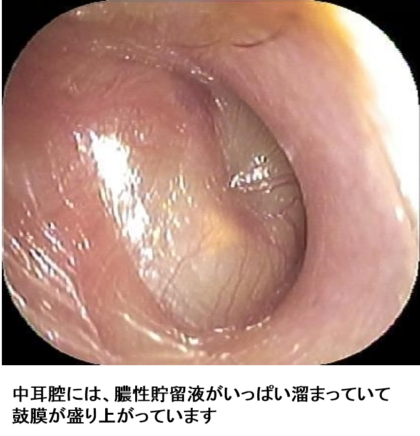 中耳炎の種類