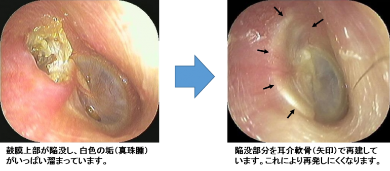 真珠腫性中耳炎の治療（1泊2日入院手術）