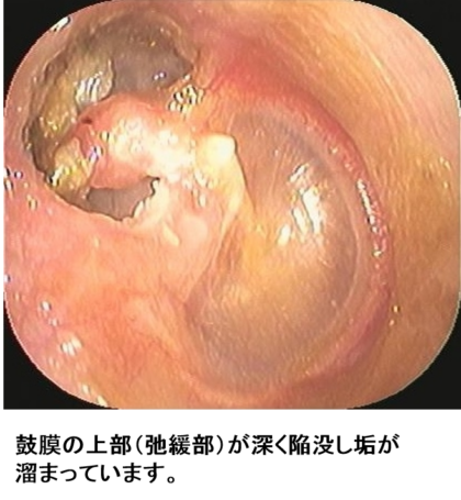 真珠腫（しんじゅしゅ）性中耳炎